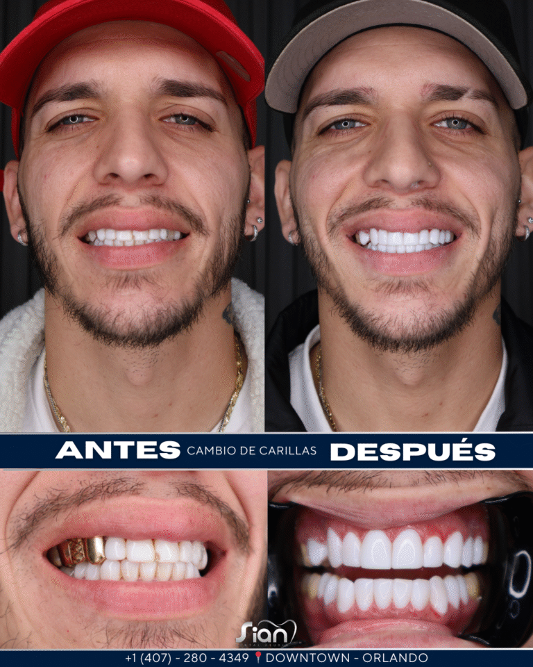 ANTES Y DESPUES